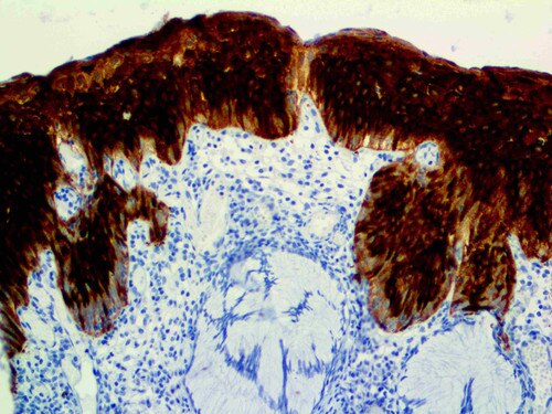 IHC of HSP-27 on a FFPE HSIL Cervix Cancer Tissue